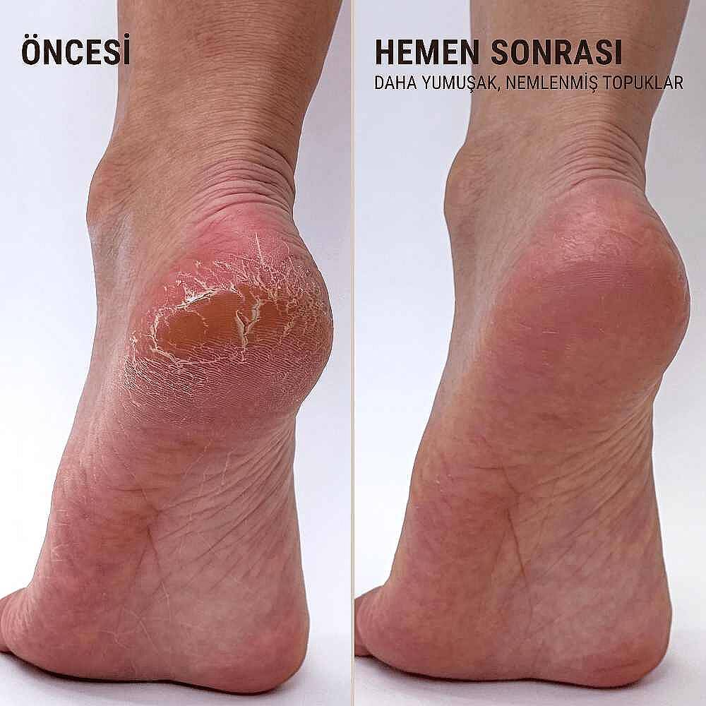 Voesh New York Topuk Onarıcı İkili Set Lavanta - 7
